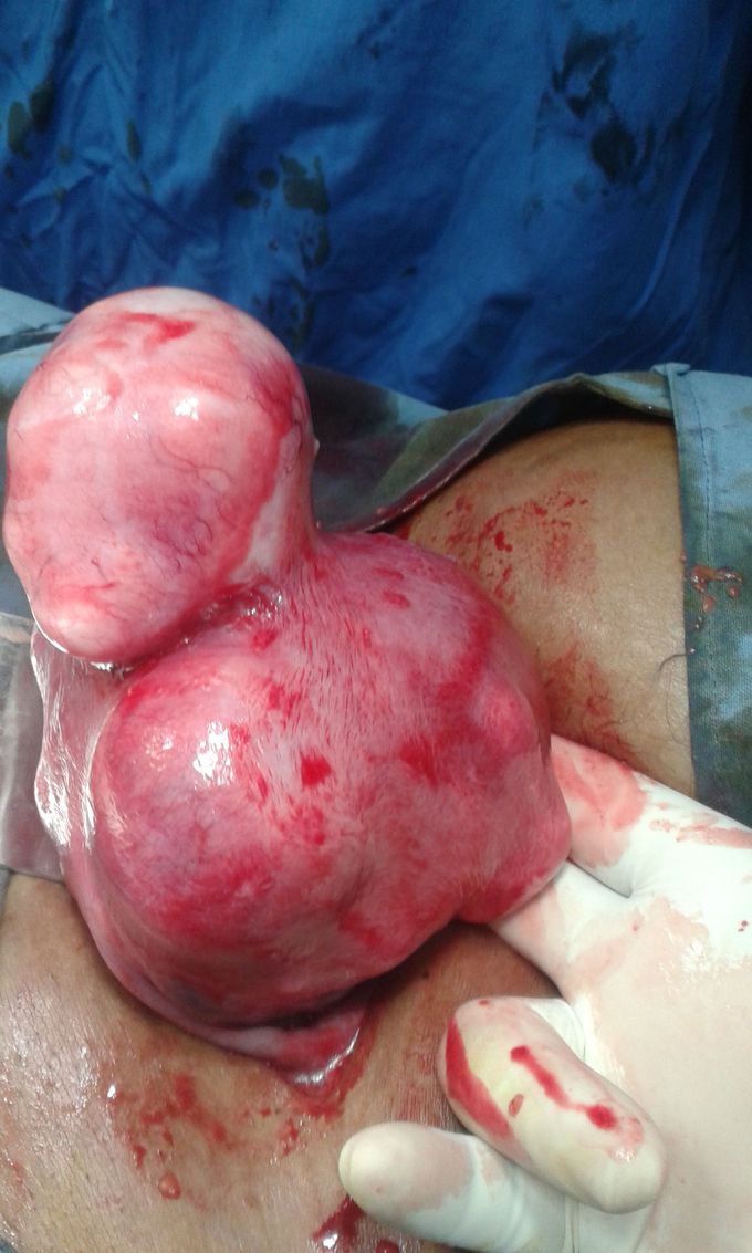 Fibroids