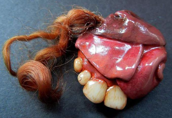 Teratoma😫😷🤓😱😨