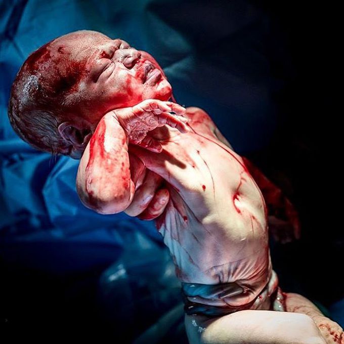Umbilical cord around the baby’s abdomen