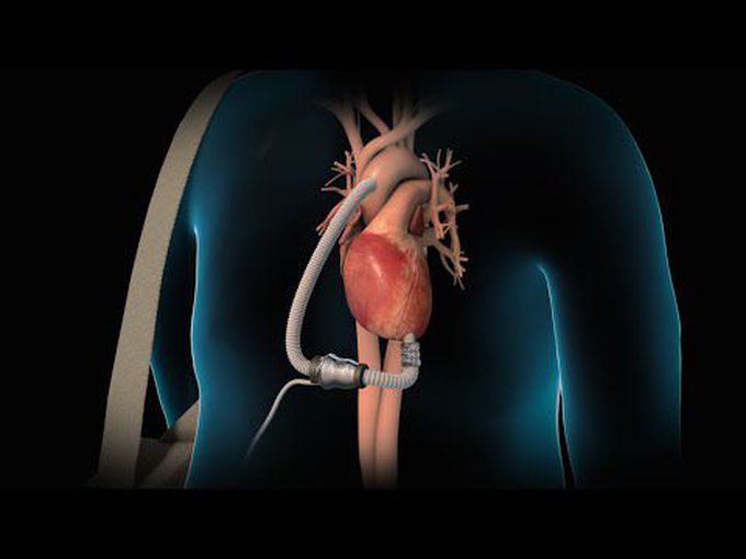 Left Ventricular Assist Device