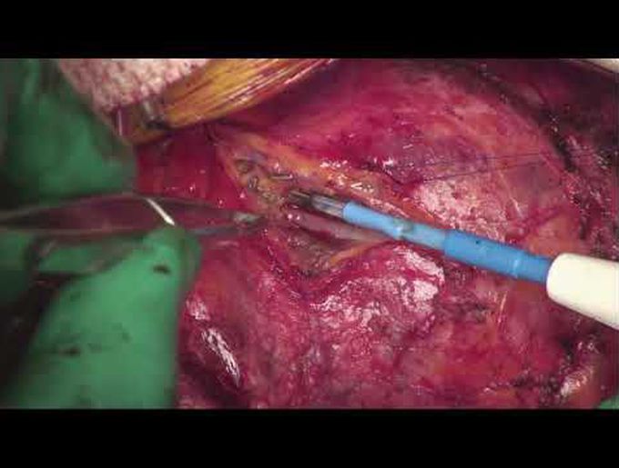 Unroofing of LAD Myocardial Bridge Combined With Right Ventricular Septal Myectomy