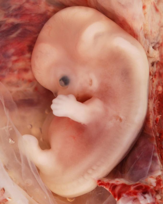 9-Week (7th week p.o.) Embryo from Ectopic Pregnancy