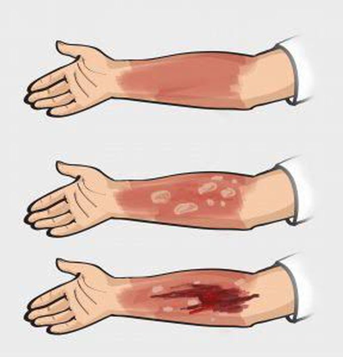 Complications of burns