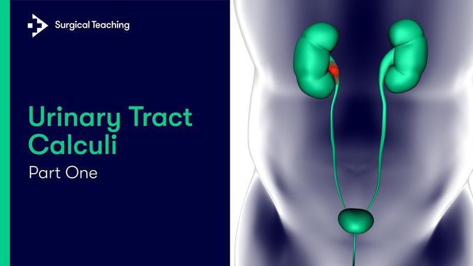 What are Kidney Stones?