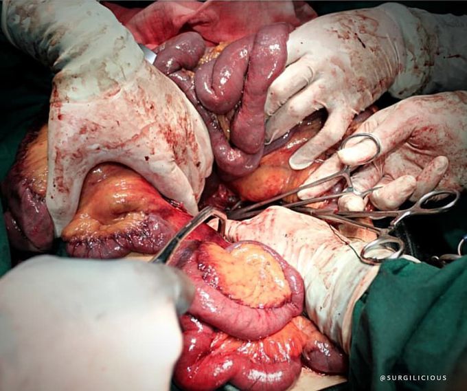 Intra-operative haemorrhage