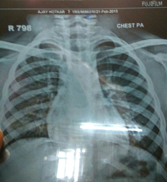 Diagnosis of Xray??