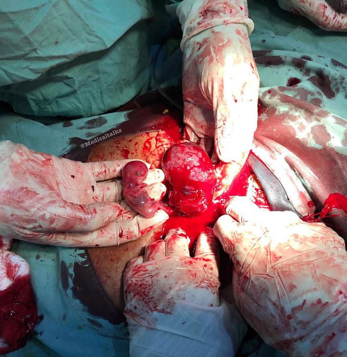 A post-laparoscopic picture of a tubal gestation that had been teased out after linear salpingostomy!! 
