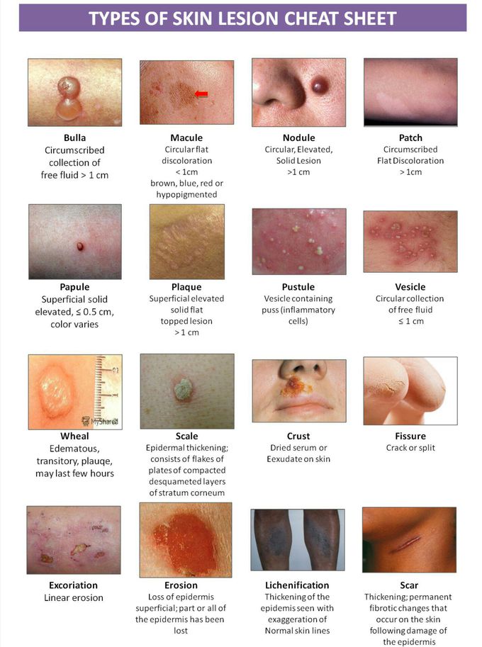 Tutorial A: The Primary Lesions

Primary lesions are physical changes in the skin considered to be caused directly by the disease process. Types of primary lesions are rarely specific to a single disease entity.

1.MACULE

A macule is a change in the color of the skin. It is flat, if you were to close your eyes and run your fingers over the surface of a purely macular lesion, you could not detect it. A macule greater than 1 cm. may be referred to as a patch.

2.	PAPULE

A papule is a solid raised lesion that has distinct borders and is less than 1 cm in diameter. Papules may have a variety of shapes in profile (domed, flat-topped, umbilicated) and may be associated with secondary features such as crusts or scales.

3.	NODULE

A nodule is a raised solid lesion more than 1 cm. and may be in the epidermis, dermis, or subcutaneous tissue.

4.	TUMOR

A tumor is a solid mass of the skin or subcutaneous tissue; it is larger than a nodule. (Please bear in mind this definition does not at all mean that the lesion is a neoplasm.)

5.	PLAQUE

A plaque is a solid, raised, flat-topped lesion greater than 1 cm. in diameter. It is analogous to the geological formation, the plateau.

6.	VESICLE

Vesicles are raised lesions less than 1 cm. in diameter that are filled with clear fluid.

7.	BULLAE

Bullae are circumscribed fluid-filled lesions that are greater than 1 cm. in diameter.

8.	PUSTULE

Pustules are circumscribed elevated lesions that contain pus. They are most commonly infected (as in folliculitis) but may be sterile (as in pustular psoriasis)

9.	WHEAL

A wheal is an area of edema in the upper epidermis.

10.	BURROW

Burrows are linear lesions produced by infestation of the skin and formation of tunnels (e.g., with infestation by the scabitic mite or by cutaneous larva migrans).

11.	TELANGIECTASIA

Telangiectasia are the permanent dilatation of superficial blood vessels in the skin and may occur as isolated phenomena or as part of a generalized disorder, such as ataxia telangiectasia.

Tutorial B: The Secondary Lesions

Secondary lesions may evolve from primary lesions, or may be caused by external forces such as scratching, trauma, infection, or the healing process. The distinction between a primary and secondary lesion is not always clear.

12.	SCALE

Scale consists of flakes or plates that represent compacted desquamated layers of stratum corneum. Desquamation occurs when there are peeling sheets of scale following acute injury to the skin.

13.	CRUST

Crusting is the result of the drying of plasma or exudate on the skin. Please remember that crusting is different from scaling. The two terms refer to different phenomena and are not interchangeable. One can usually be distinguished from the other by appearance alone.

14.	ATROPHY

Atrophy is thinning or absence of the epidermis or subcutaneous fat.

15.	LICHENIFICATION

"Lichenification" refers to a thickening of the epidermis seen with exaggeration of normal skin lines. It is usually due to chronic rubbing or scratching of an area.

16.	EROSION

Erosions are slightly depressed areas of skin in which part or all of the epidermis has been lost.

17.	EXCORIATION

Excoriations are traumatized or abraded skin caused by scratching or rubbing.

18.	FISSURE

A fissure is linear cleavage of skin which extends into the dermis.

19.	ULCERATION

Ulcerations occur when there is necrosis of the epidermis and dermis and sometimes of the underlying subcutaneous tissue.

20.	SCAR

Scars are the permanent fibrotic changes that occur on the skin following damage to the dermis. Scars may have secondary pigment characteristics.

21.	ESCHAR

An eschar is a hard, usually darkened, plaque covering an ulcer implying extensive tissue necrosis, infarcts or gangrene.

22.	KELOIDS

Keloids are an exaggerated connective tissue response of injured skin that extend beyond the edges of the original wound.

23.	PETECHIAE, PURPURA, AND ECCHYMOSES

Three terms that refer to bleeding that occurs in the skin are petechiae, purpura, and ecchymoses. Generally, the term "petechiae" refers to smaller lesions. "Purpura" and "ecchymoses" are terms that refer to larger lesions. In certain situations purpura may be palpable. In all situations, petechiae, ecchymoses, and purpura do not blanch when pressed. If there is any question, press on the lesions carefully with a glass slide. Don't break the slide or cut the patient.

Tutorial C: Patterns and Distribution

Not only is the appearance of lesions important, but the pattern and distribution on the skin is as well.

24.	ANNULAR

Annular lesions are seen in a ring shape. Tinea corporis, erythema migrans (the lesion associated with lyme disease), and granuloma annulare are three common examples.

25.	DISCRETE

Discrete lesions tend to remain separate. This is a helpful descriptive term but has little specific diagnostic significance.

26.	CLUSTERED

Clustered lesions are those that are grouped together. They are commonly seen in herpes simplex or with insect bites, for example.

27.	CONFLUENT

Confluent lesions tend to run together.

28.	DERMATOMAL, ZOSTERIFORM

Dermatomal, zosteriform lesions follow a dermatome. The lesions of varicella zoster (also known as shingles) are the classic example, but there are other lesions which may assume the same pattern.

29.	ECZEMATOID

Eczematoid lesions are inflamed with a tendency toward clustering, oozing, or crusting.

30.	FOLLICULAR

It is sometimes helpful to determine if lesions specifically involve the hair follicle.

31.	GUTTATE

Guttate lesions look as though someone took a dropper and dropped this lesion on the skin. Guttate lesions are characteristic of one form of psoriasis, though that is not the only example.

32.	IRIS OR TARGET LESIONS

Iris lesions are also known as target lesions and are a series of concentric rings. These have a dark or blistered center. These lesions are frequently seen with erythema multiforme but not exclusively so.

33.	KOEBNER PHENOMENON

The Koebner phenomenon, also called the isomorphic response, refers to the appearance of lesions along a site of injury. This phenomenon is seen in a variety of conditions; for example, lichen planus, warts, molluscum contagiosum, psoriasis, lichen nitidus, and the systemic form of juvenile rheumatoid arthritis.

34.	LINEAR LESIONS

Linear lesions occur in a line or band-like configuration. This descriptive term may apply to a wide variety of disorders. (One should be certain that the lesions are not following a dermatome.)

35.	MULTIFORM

Patients with multiform lesions have lesions of a variety of shapes.

36.	RETICULAR

Reticular or net-like lesions can be seen in a variety of circumstances; e.g., very commonly in newborns (or even grown children and adults) as cutis marmorata, or with livedo reticularis. The former fades as the skin is warmed the latter becomes more florid.

37.	SERPIGINOUS

Serpiginous lesions wander as though following the track of a snake.

38.	UNIVERSALIS

Universalis refers to a widespread disorder that affects the entire skin.

39.	SCARLATINIFORM

Scarlatiniform rashes have the pattern of scarlet fever. The patient with a scarlatiniform rash has innumerable small red papules that are widely and diffusely distributed. Note that the term scarlatiniform does not mean that the patient has scarlet fever, although by definition all patients with scarlet fever have a scarlatiniform rash. Patients with a variety of other conditions such as Kawasaki disease, viral infections, or drug reactions may have rashes with the same pattern.

40.	STRAWBERRY TONGUE

Patients with scarlet fever, Kawasaki disease or other conditions may develop a distinctive appearance of their tongues. Because of its resemblance to the well-known berry, the appearance is called "strawberry tongue."

41.	MORBILLIFORM

The term "morbilliform" means that the patient has a rash that looks like measles. Patients with measles will have the rash but patients with Kawasaki disease, drug reactions, or other conditions may also have a morbilliform rash. The rash consists of macular lesions that are red and are usually 2-10 mm in diameter but may be confluent in places.

42.	SATELLITE LESIONS

The term is commonly used to describe a portion of the rash of cutaneous candidiasis in which a beefy red plaque may be found surrounded by numerous, smaller red macules located adjacent to the body of the main lesions.

43.	PATTERNS OF INTENTIONAL OR UNINTENTIONAL INJURY

One important category of skin lesions involve the form that skin lesions may take in cases of child abuse or other intentional injury (bite marks, slap marks, strap marks, burns, etc.) or in cases of unintentional injury. Abrasions are traumatically caused erosions.