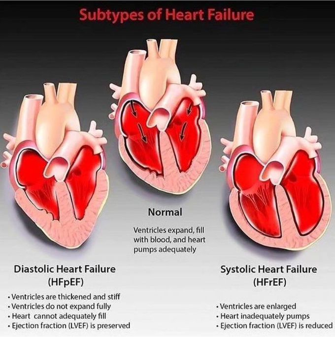 Subtypes of Heart Failure