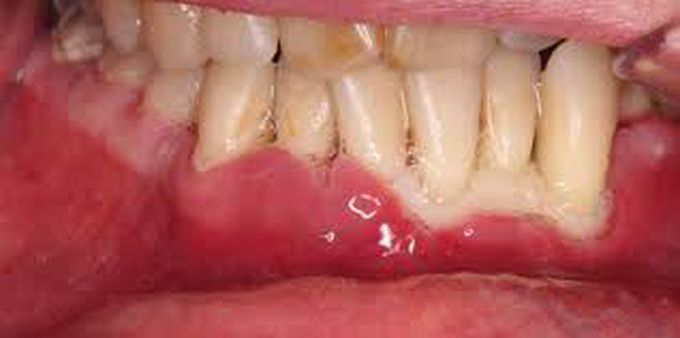 Symptoms of Acute necrotizing ulcerative periodontitis