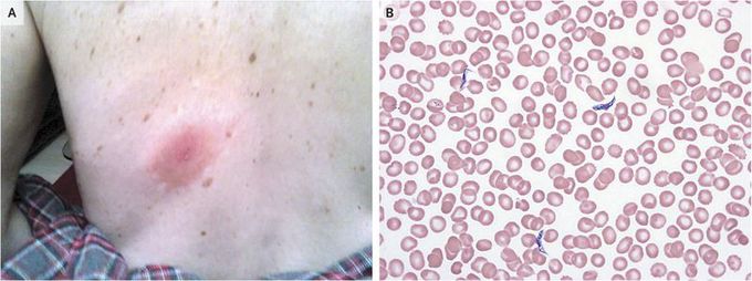 African Trypanosomiasis