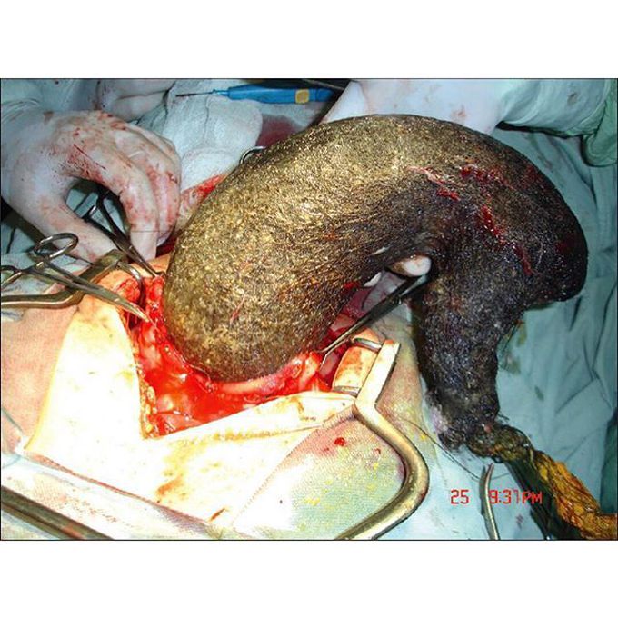 Removing a giant trichobezoar (hair ball) from the stomach!  