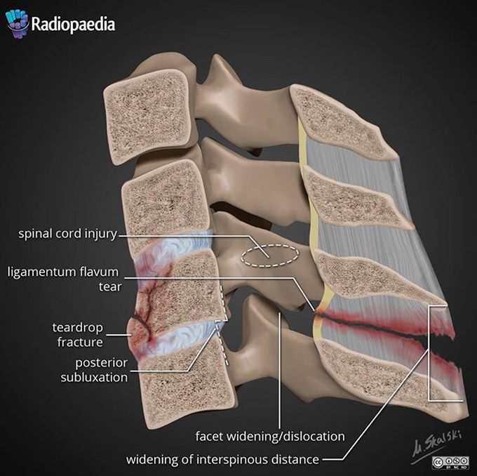 Spinal injury