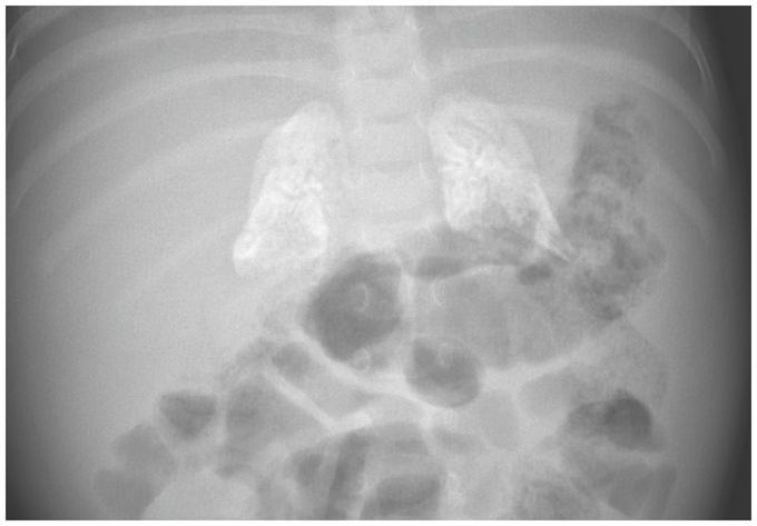 Adrenal Calcifications in an Infant