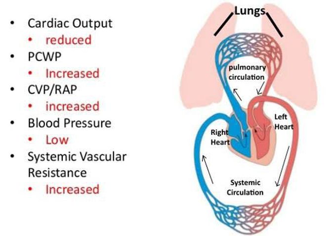 Cardiogenic shock