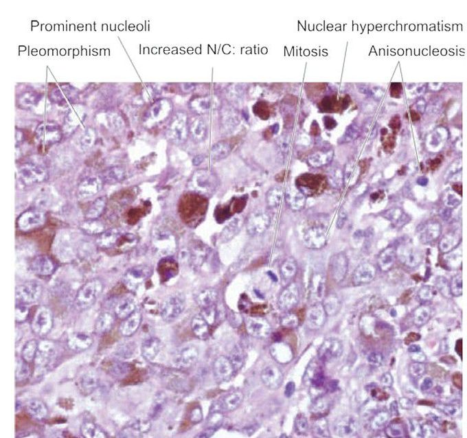 Malignant cells