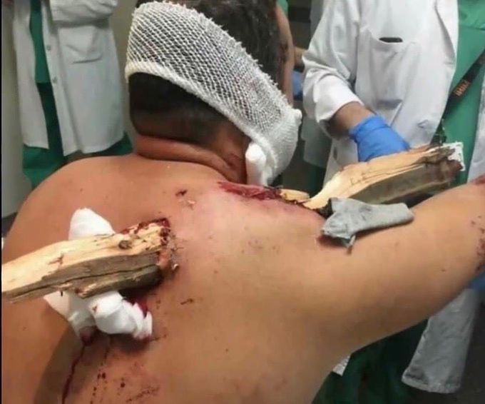 Case of a 30 year old male who had been cutting down a tree branch, when he fell 20 feet and became impaled by a large piece of wood. 