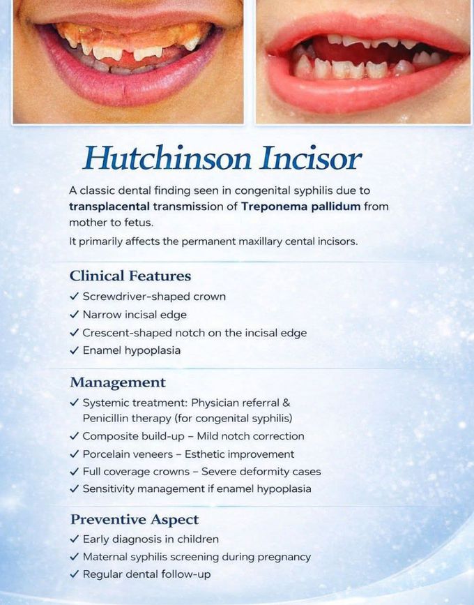 Hutchinson's Incisors