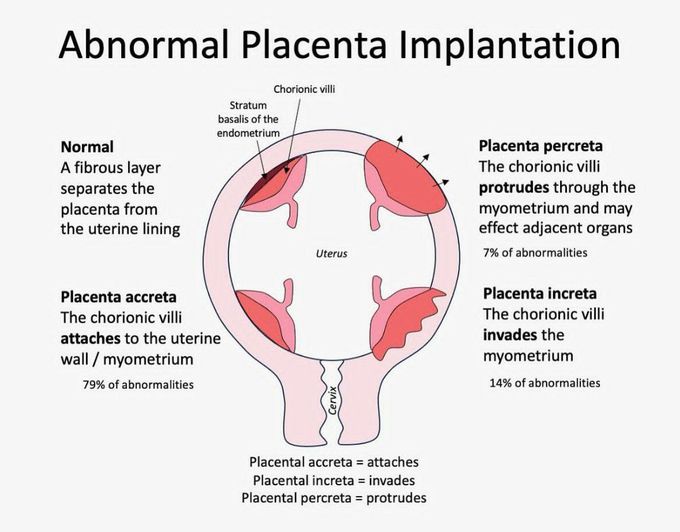 Abnormal Placenta Implantation