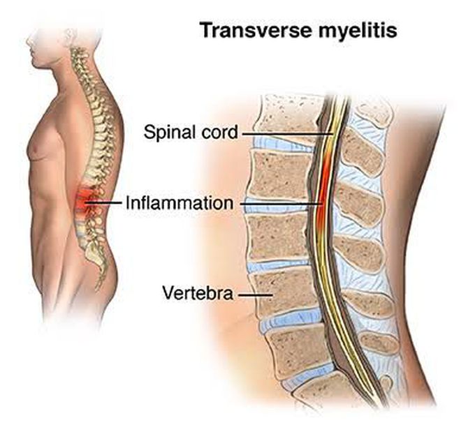Symptoms of transverse myelitis