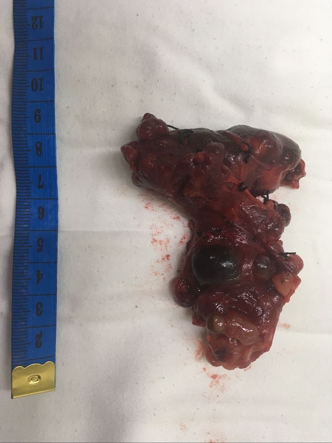 Total Thyroidectomy