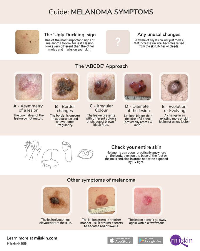 Symptoms of Melanoma