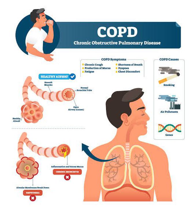 Following are the symptoms of COPD
