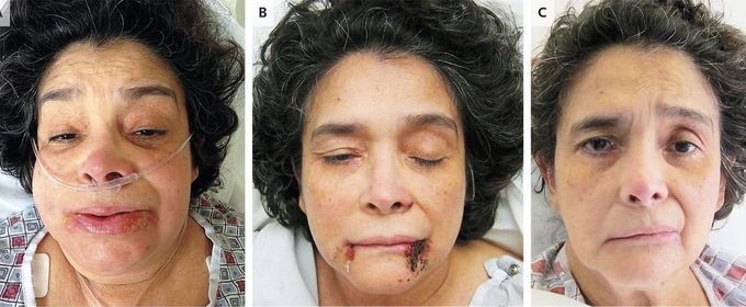Herpes Labialis and Facial-Nerve Paralysis