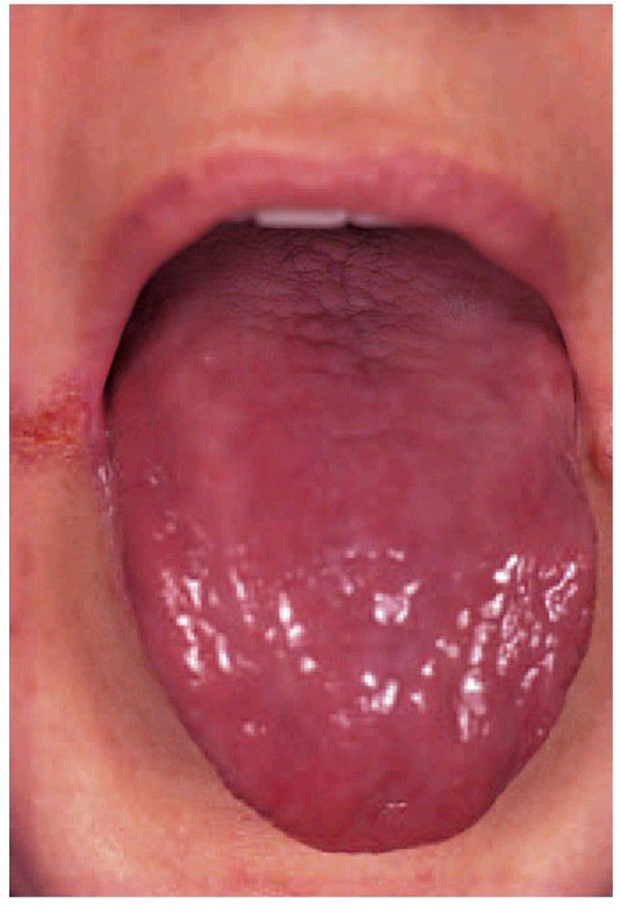 Glossitis in iron-defi ciency anaemia