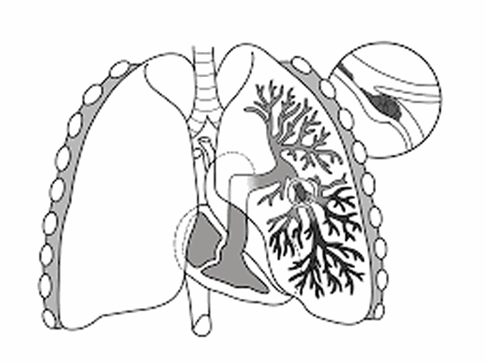 Symptoms of pulminary embolism