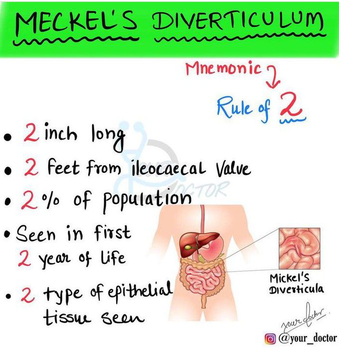 Meckle's Diverticulum