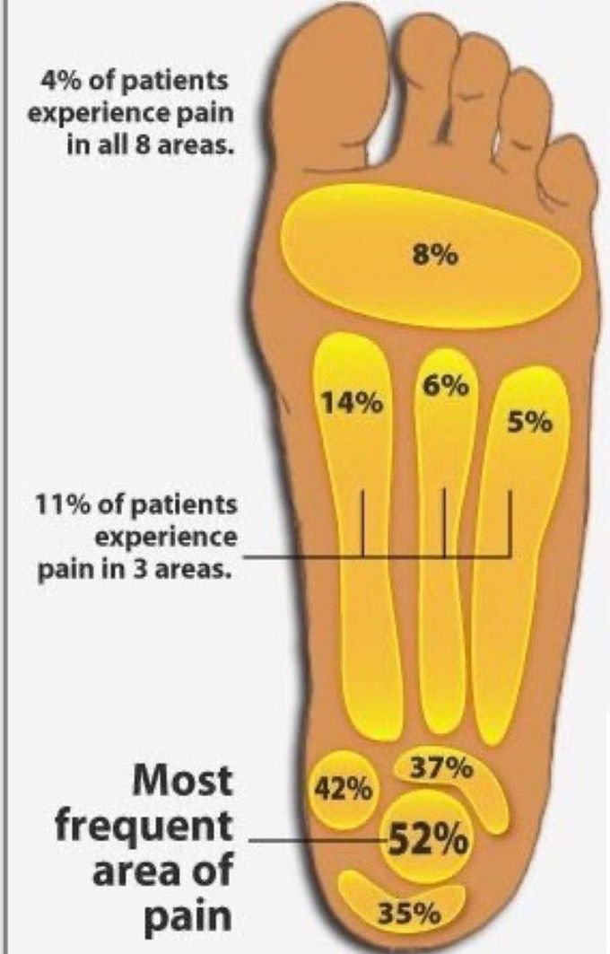 Plantar Fascitis