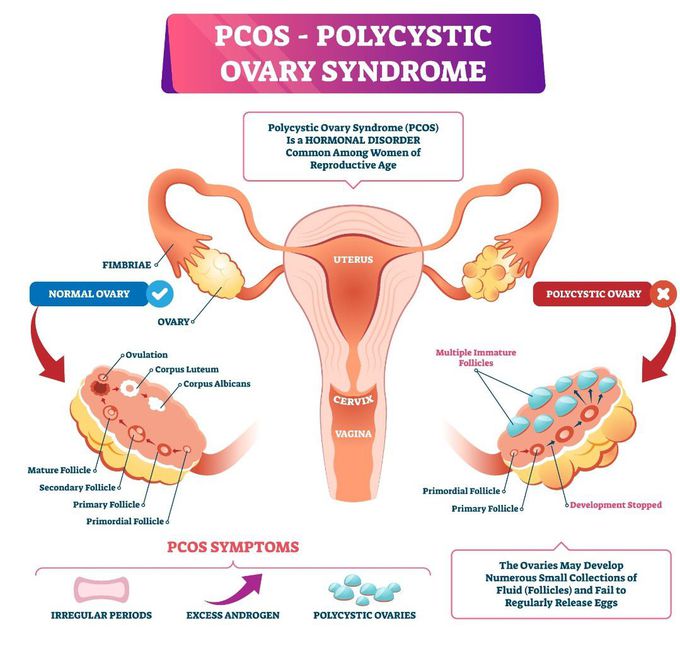 PCOS Review