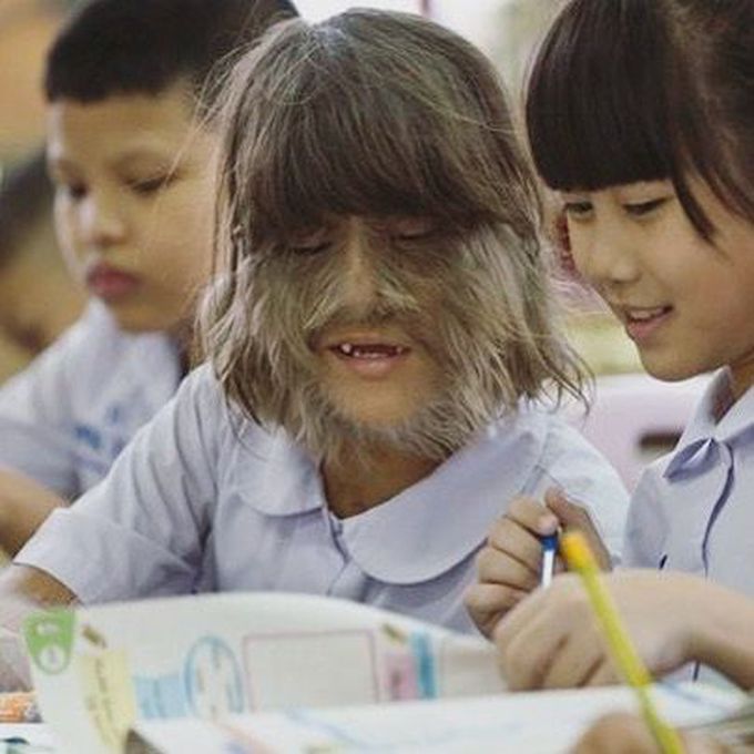 Hypertrichosis