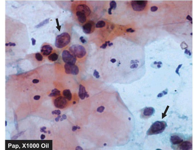 High-grade squamous intraepithelial lesion (H-SIL)