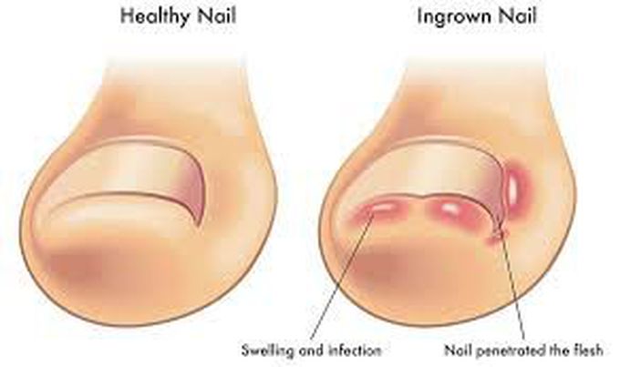 Symptoms of ingrown toenail