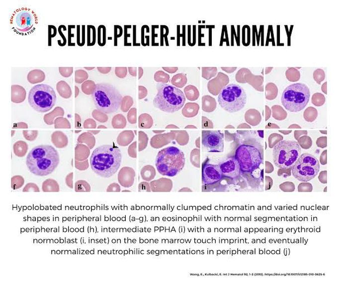 Pseudo-Peliger-Huet-Anomaly