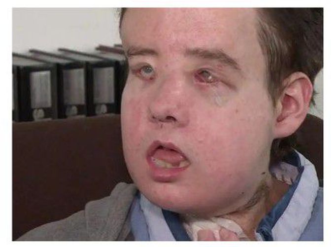 A French man became the first person to receive two face transplants.