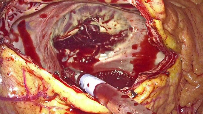Totally Endoscopic Redo Tricuspid Valve Repair