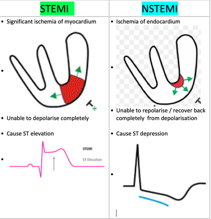 Indications of myocardial infarction via echocardiogram