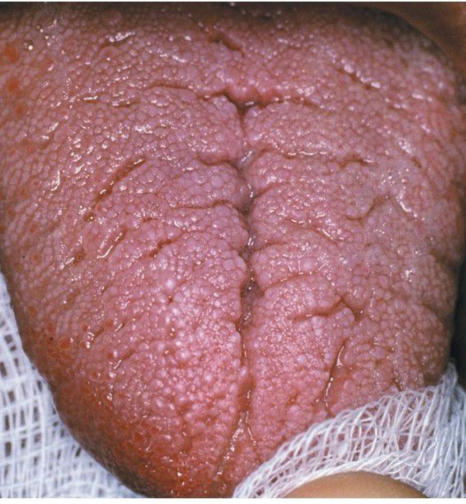 Orofacial Granulomatosis (Melkersson-Rosenthal Syndrome). 