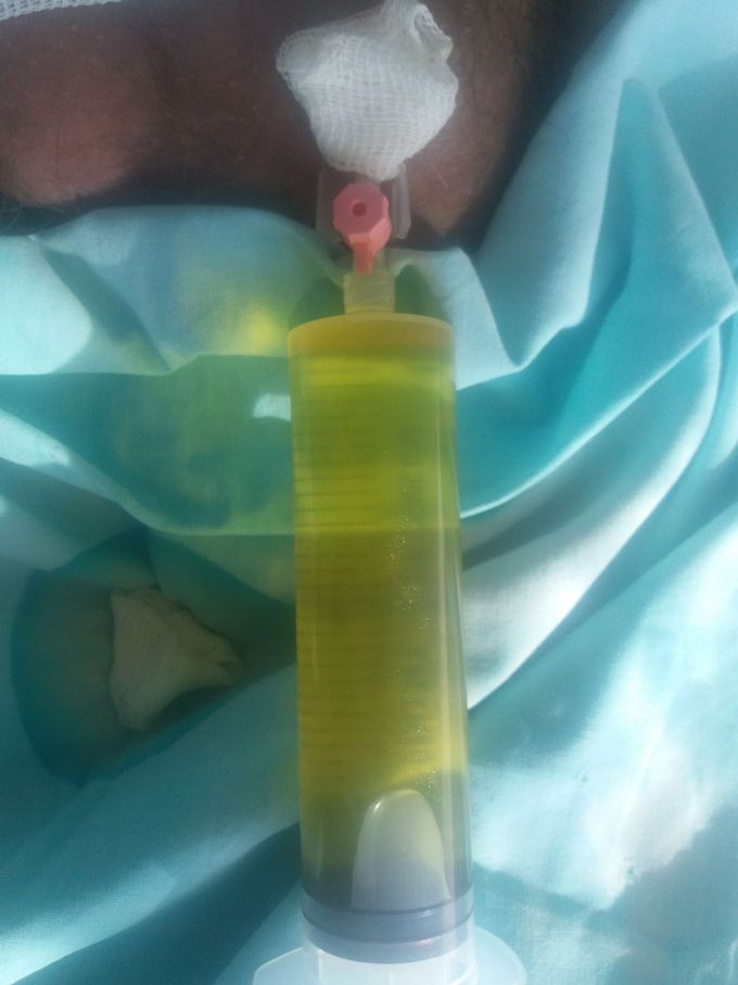 Hydro from scrotum