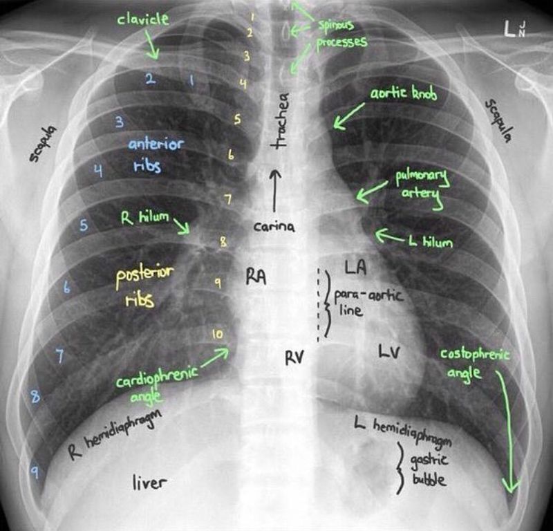 Labeled Chest X Ray Google Search Radiology Schools