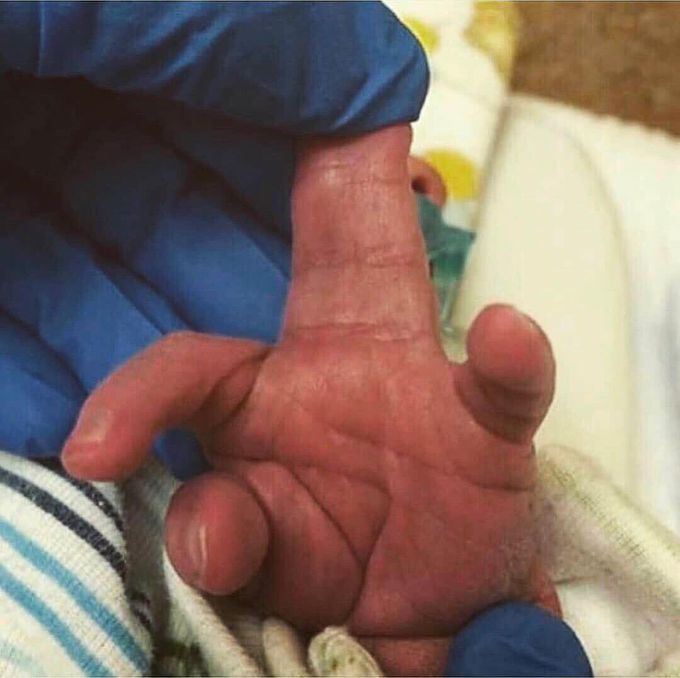 Syndactyly