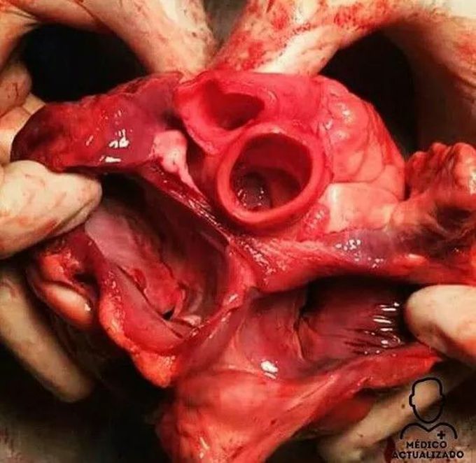 Heart Valves