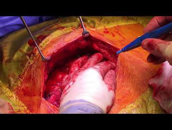 A Simple Technique to Manage Sternal Wound Dehiscence