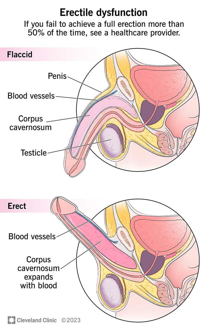 Erectile Dysfunction