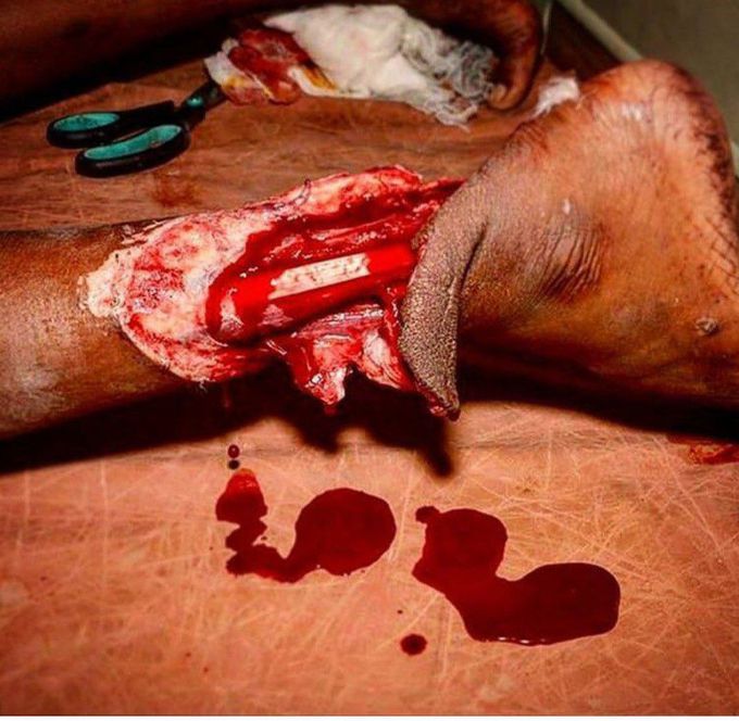 Injury in leg whats the cause