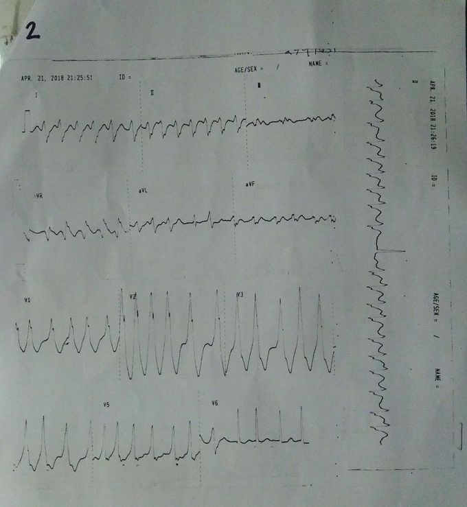 ECG INTERPRETATION?
