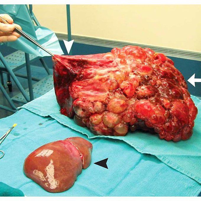 Polycystic liver